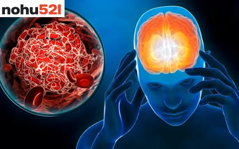 Những việc tuyệt đối không nên làm khi nghi ngờ đột quỵ